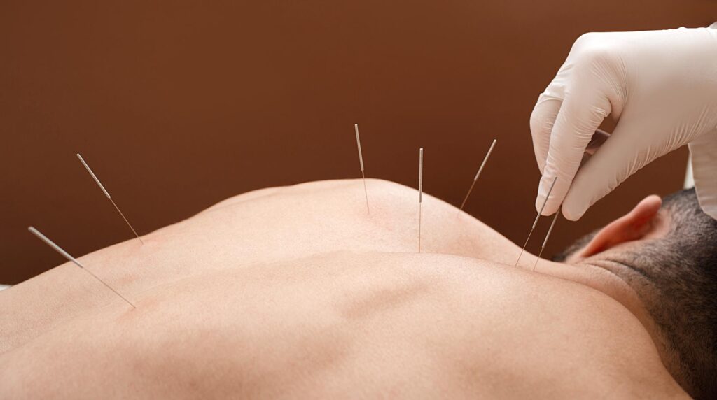 Nærbilde av akupunkturbehandling med nåler i ryggen, brukt for smertelindring og helsefremmende tiltak.